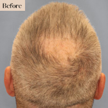 neograft hair transplant new jersey before treatment image